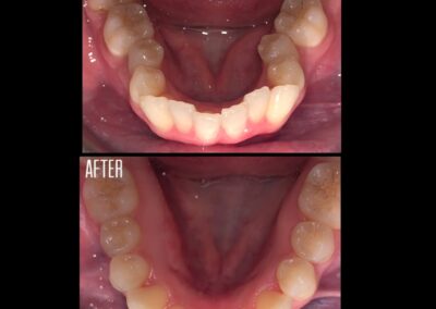 Invisalign before and after 3
