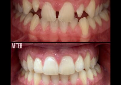 Invisalign before and after