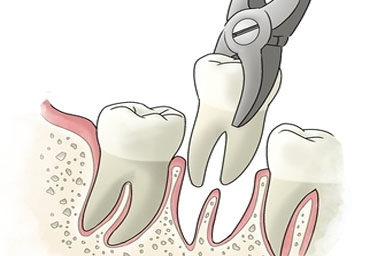 Tooth extraction Lifetime Dental