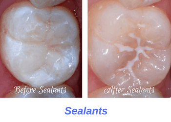 Sealants Lifetime Dental