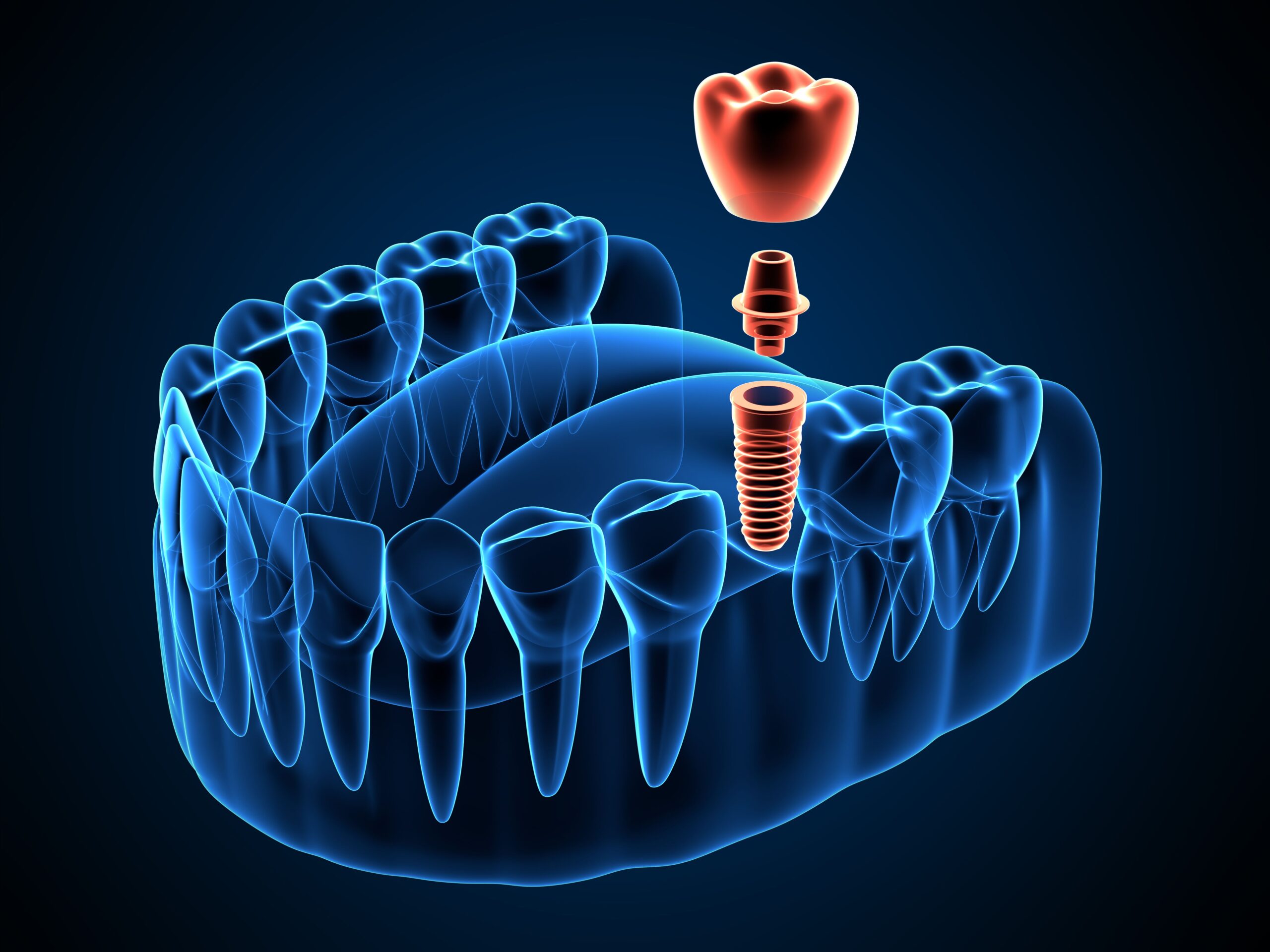 3d render of jaw x-ray with dental implant placement 3d render of jaw x-ray with dental implant placement
